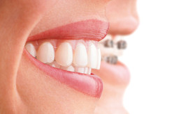 Dientes con tratamiento de ortodoncia invisible Invisalign